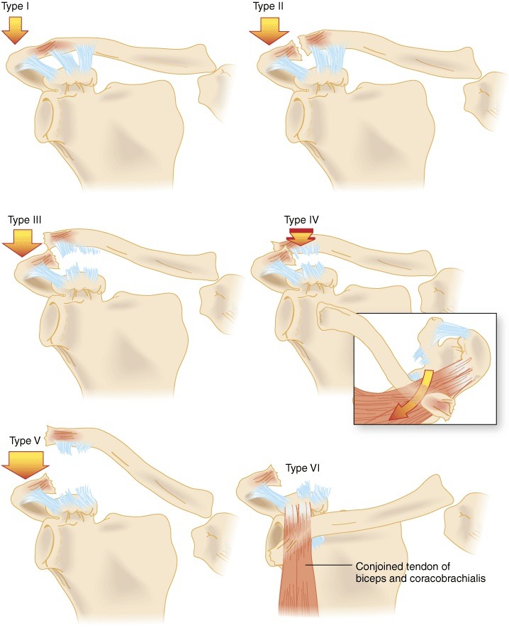 AC Joint Separation.jpg