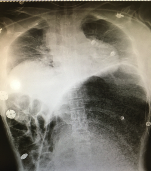 File:Acutegastricdilation.png