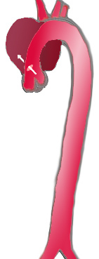 File:AoDissect DeBakey2.png
