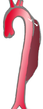 File:AoDissect DeBakey3.png