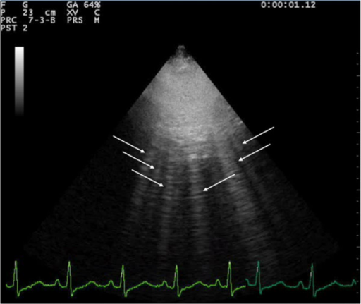 File:B-lines.png