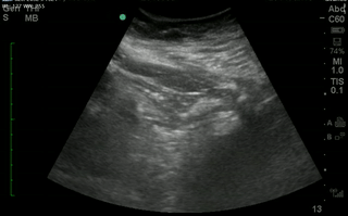 Bladder sagittal.gif