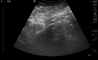 Bladder transverse.gif