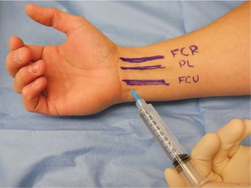 File:Blind Ulnar Nerve Block.jpg