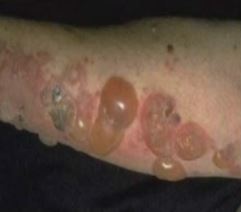 Bullous pemphigoid.JPG