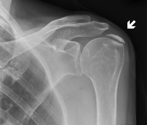 File:Calcific Tendinitis.jpg