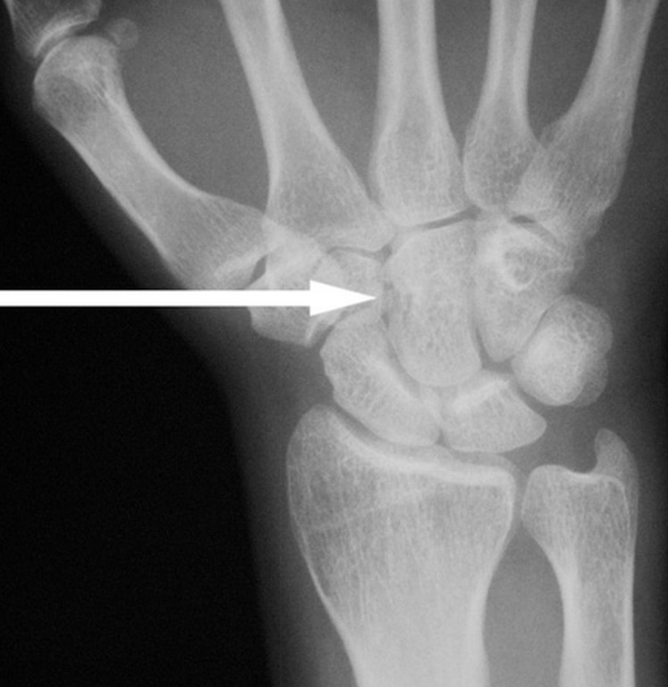 Capitate Fracture.jpg