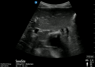 Celiac and SMA identified