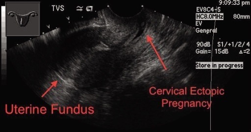 File:Cervical ectopic.jpg