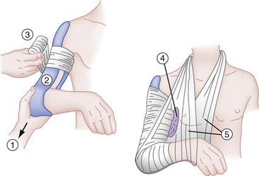 File:Coaptation splint.jpg