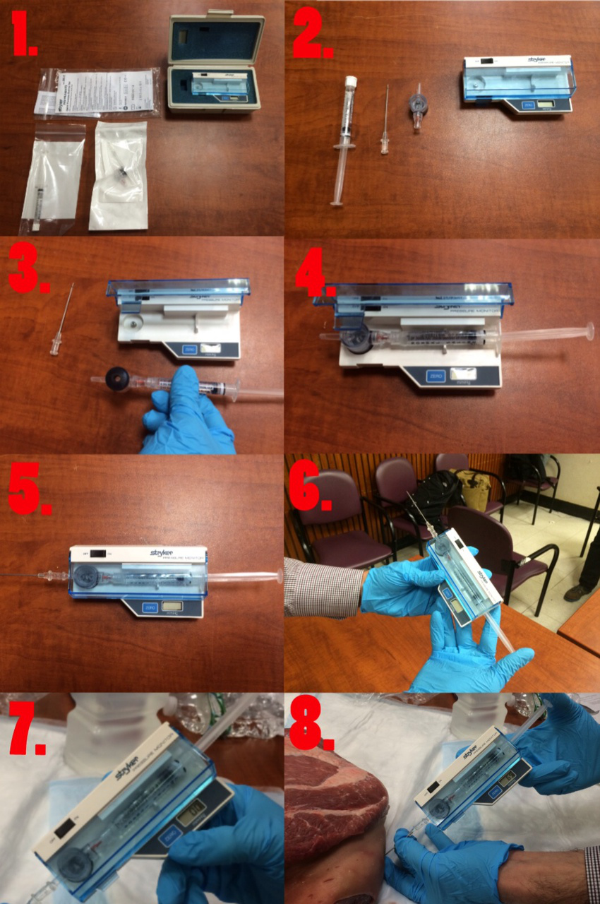 Steps to measure compartment pressure using a striker needle