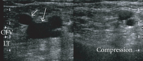 Compression of Femoral Vein.png