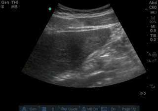 File:Contracted Gallbladder.gif
