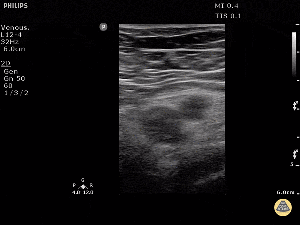 Incompressible left Common Femoral Vein[4]
