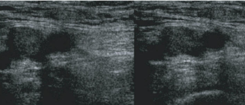 DVT in the Femoral Vein.png