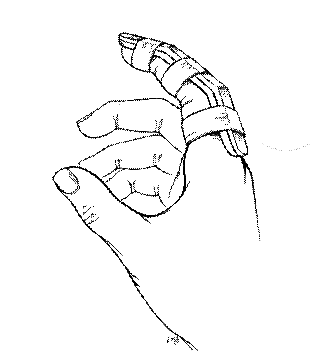 File:Dorsal Volar Finger Splint.gif