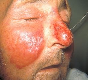 Erysipelas well demarcated.JPG