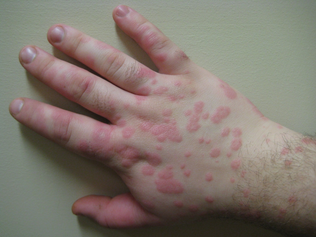 Erythema multiforme minor of the hand