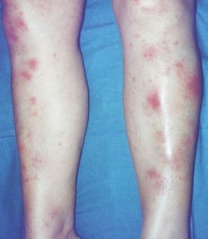 Erythema nodosum.JPG