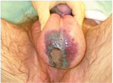 File:Fournier-Gangrene.png
