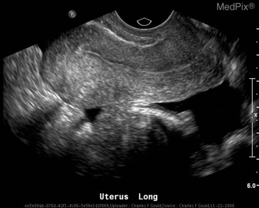 File:Free fluid ectopic.png