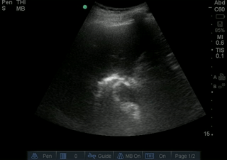 File:GB Edema.gif