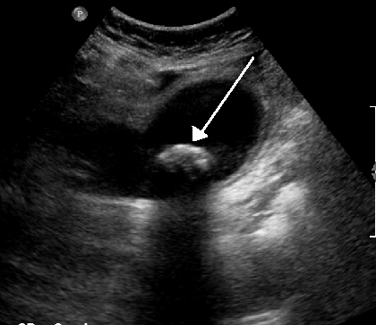 File:Gallstones.png