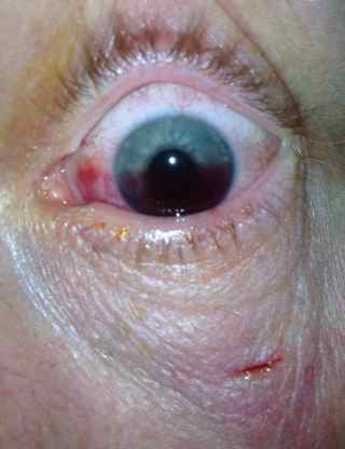 File:Hyphema.jpeg