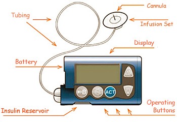 File:InsulinPumpALIEM.jpg