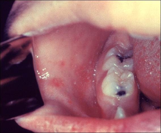 File:Koplik's Spots on Cheek.jpg