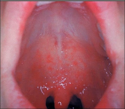 File:Koplik's Spots on Palate.jpg