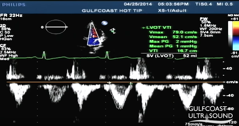 File:LVOT VTI.png