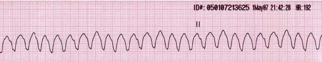 File:Lead II rhythm ventricular tachycardia Vtach VT.jpg