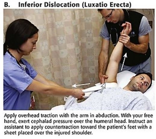 File:Luxatio erecta.jpg