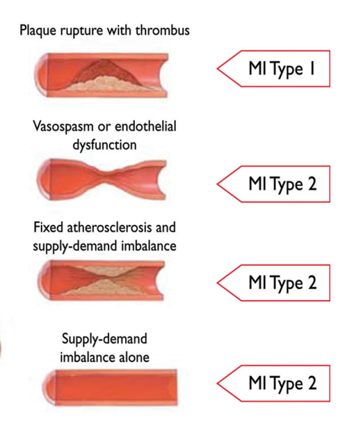 thumbnailMyocardial Infarction types