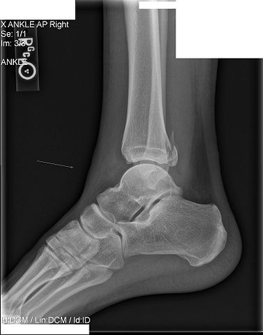 File:Maisonneuve fracture.jpg