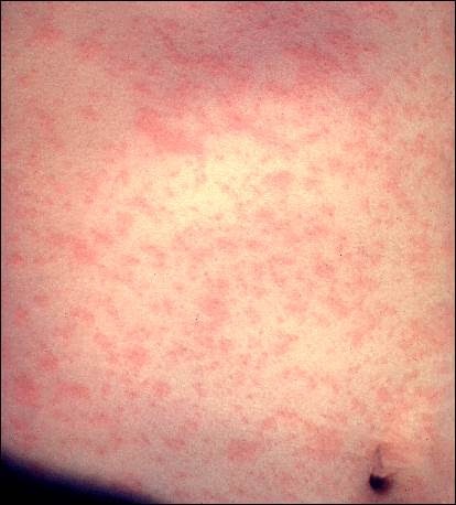 File:Measle's Rash on on Thorax.jpg