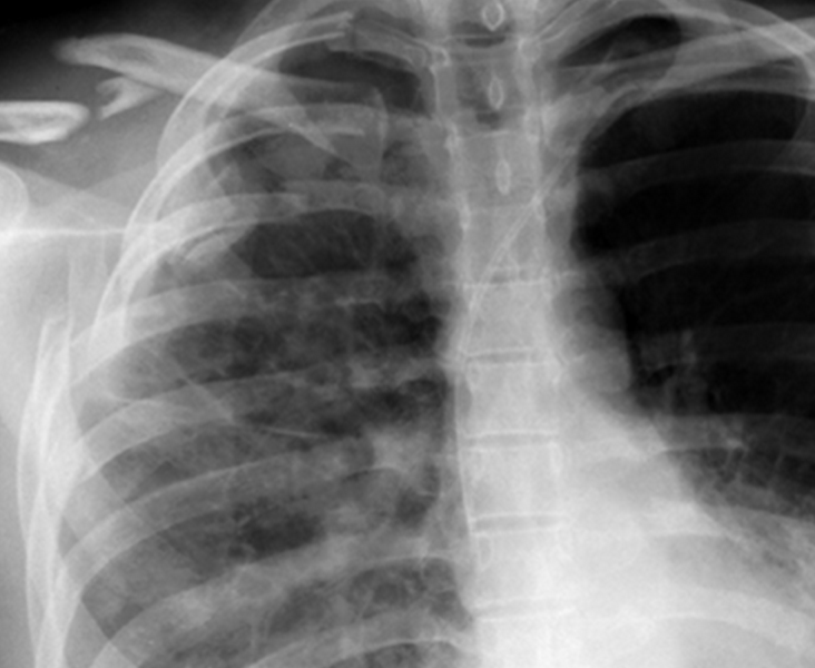 File:Multipleribfractures.png