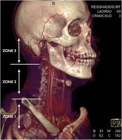 File:Neck zones.png