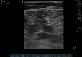 No DVT fem 2.gif