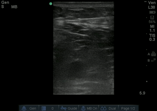 No DVT pop.gif