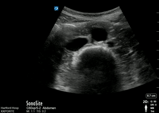 Aortic bifurcation