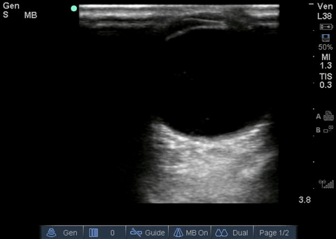 File:Ocular - Retinal detachment.gif