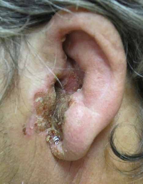 File:OtitisExterna severe.jpg