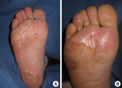 Second degree frostbite