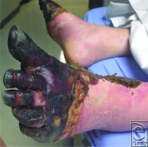 Fourth degree frostbite