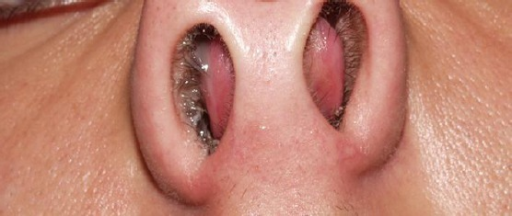 Bilateral septal hematoma