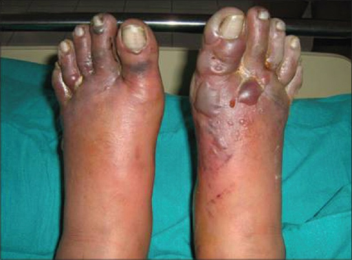 Third degree frostbite