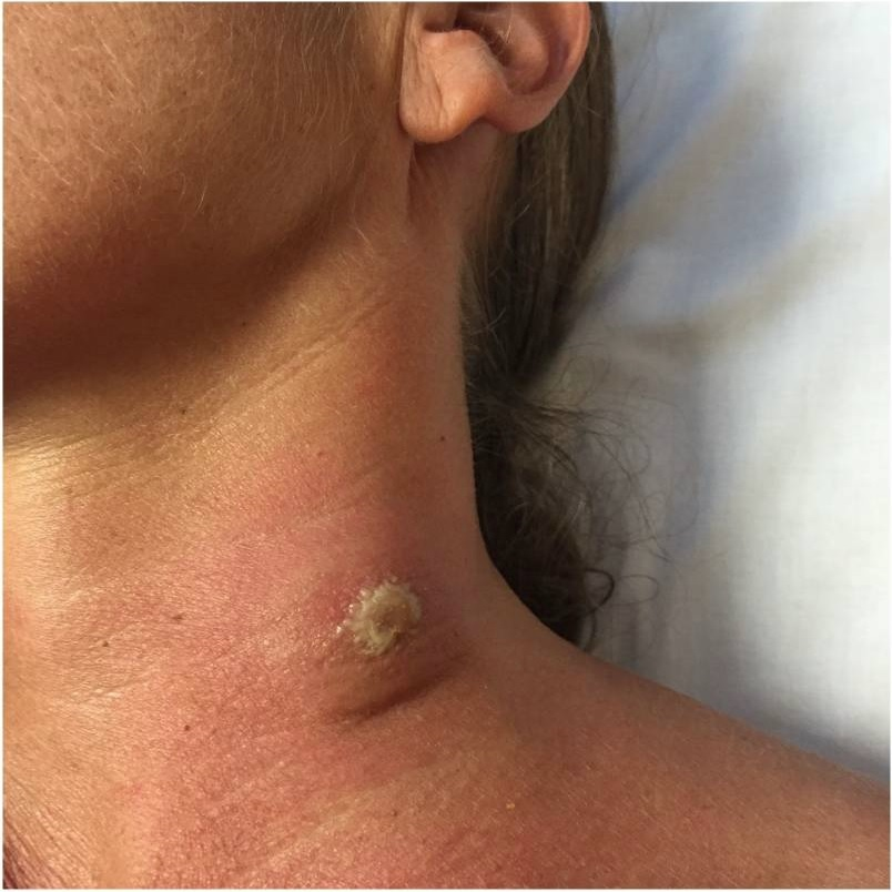 Cervical LAD in African trypanosomiasis
