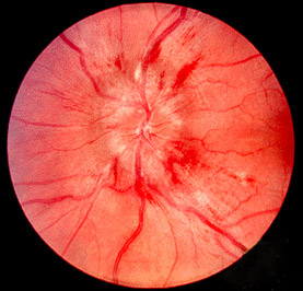 Papilledema.jpg
